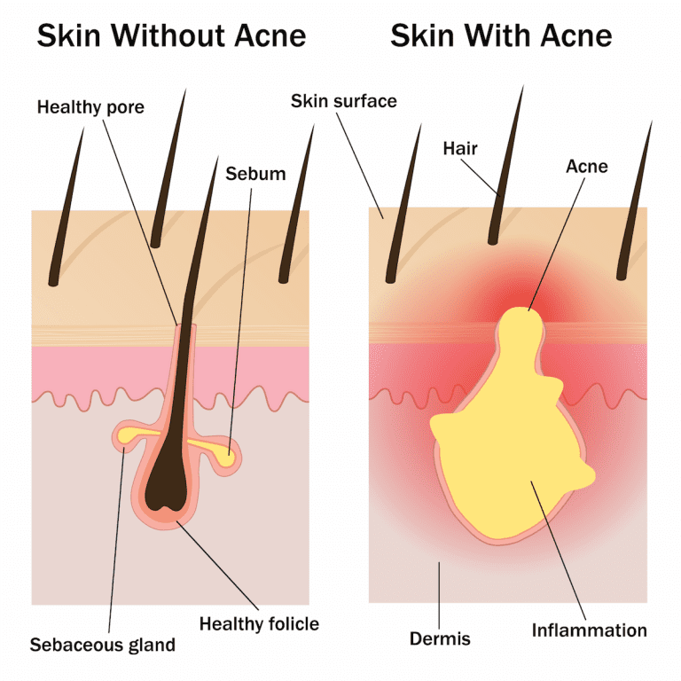 Acne is the result of an inflamed or infected sebaceous gland. Laser therapy can be an effective way to target these inflamed glands.