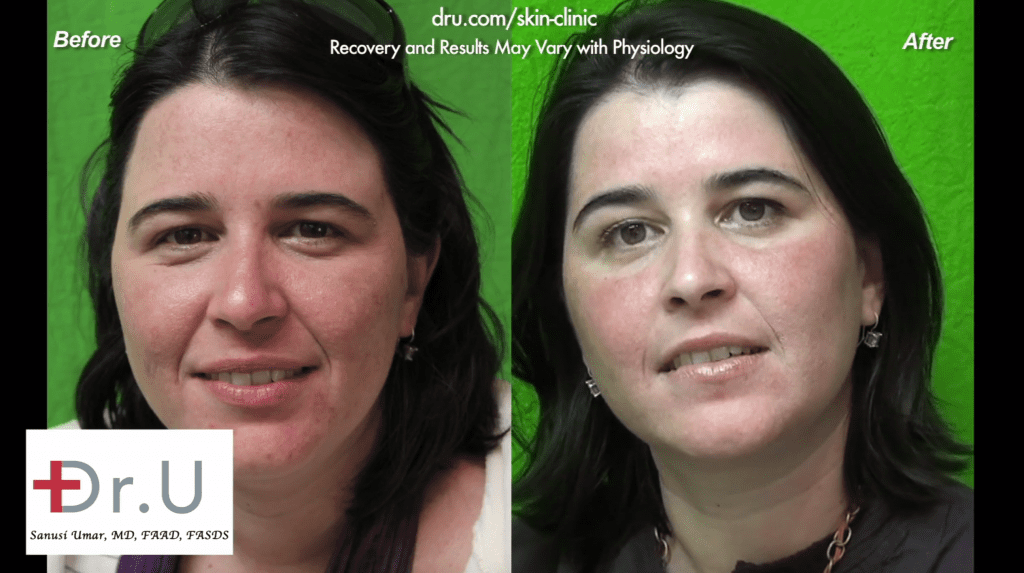 This patient consulted Dr. U in Los Angeles for adult acne treatment. She is happy with her results.