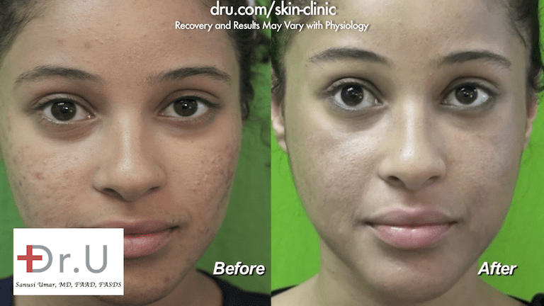 The patient was happy to see the results of her laser skin acne treatment. After targeting the remaining acne, Dr. U focused on the acne scars underneath.*