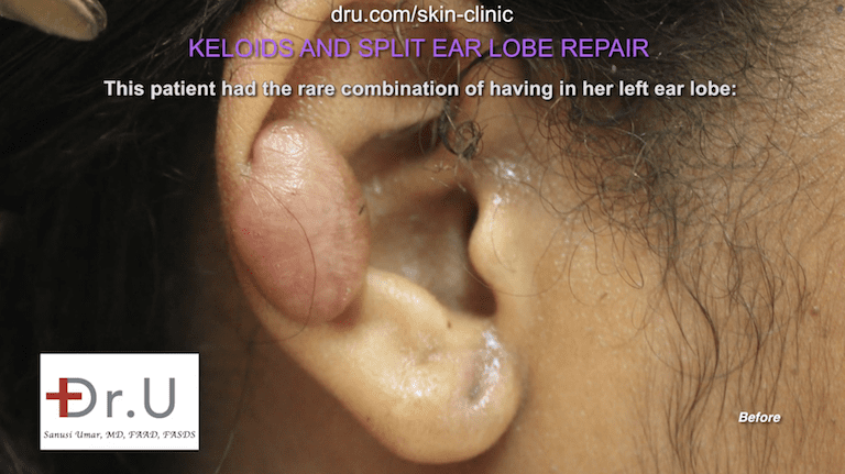 Split Earlobe Keloid