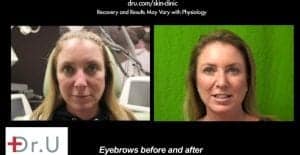 Before and after Botox for eyebrow lift. The El Segundo, Los Angeles patient is happy and no longer wonders ,"how long does Botox last on the crows feet area?*