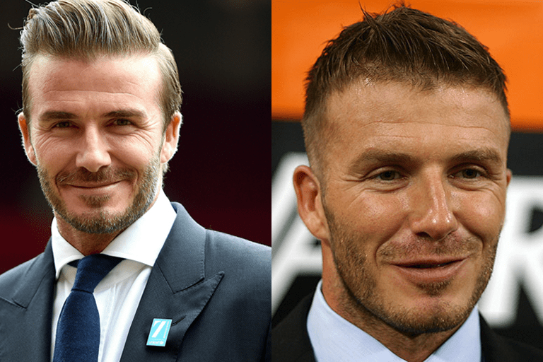 Video: How To Style Your Hair Like David Beckham Hair Tranplant or Not