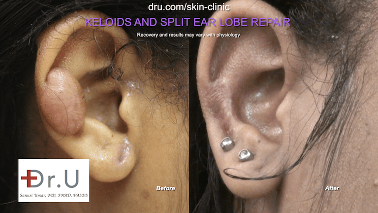 KRF Clinical Practice Guidelines in Keloid Disorder  Magnetic Disks  Version 12019