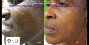 Left side comparison photos shows a major clearance of dark skin tags on the face.