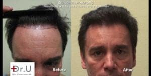 A hair transplant with a natural hairline should have a soft outer edge.