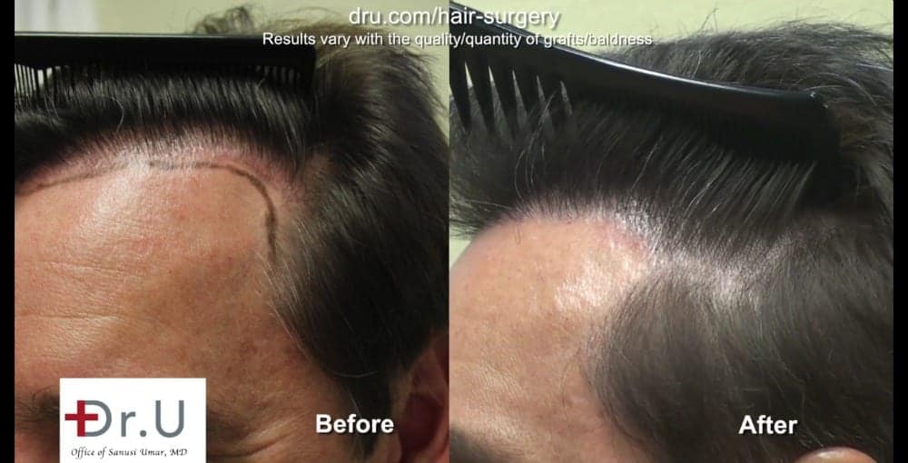 Derma Roller For Hair Growth: Expert Review 2023 - Wimpole Clinic