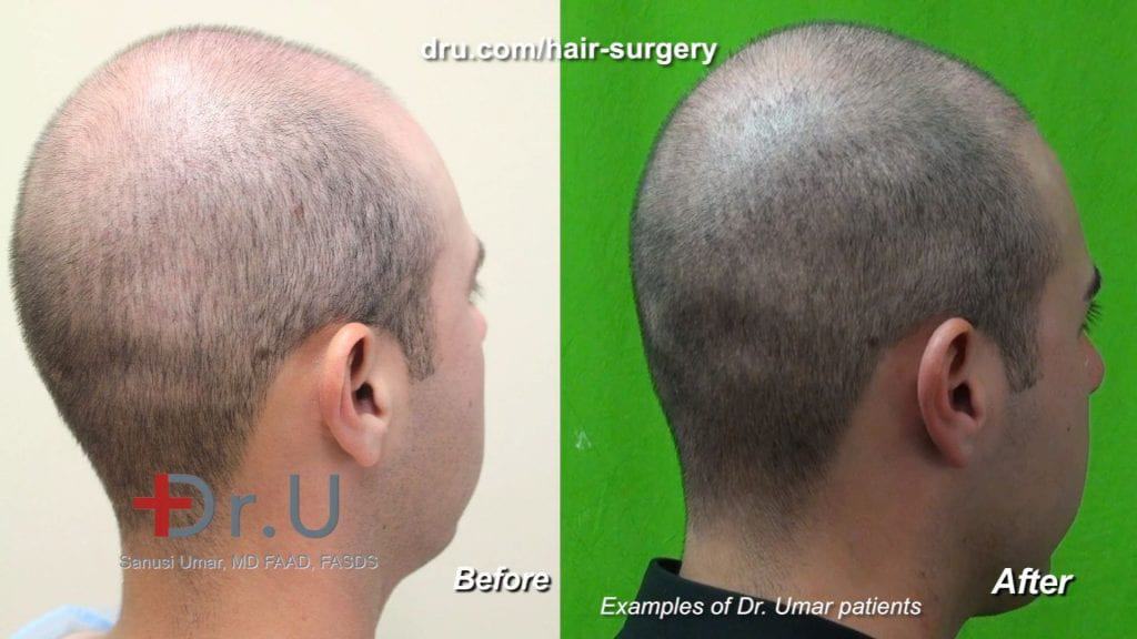 dr-u-shares-an-overview-of-the-hair-transplant-process-and-what-to