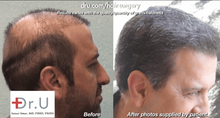 What Causes Low Growth Yield Following a Hair Transplant? - Dr. U Hair &  Skin Clinic | FUE Hair Restoration, Dermatology and Laser Surgery | Los  Angeles, Manhattan Beach | Dr Sanusi Umar MD