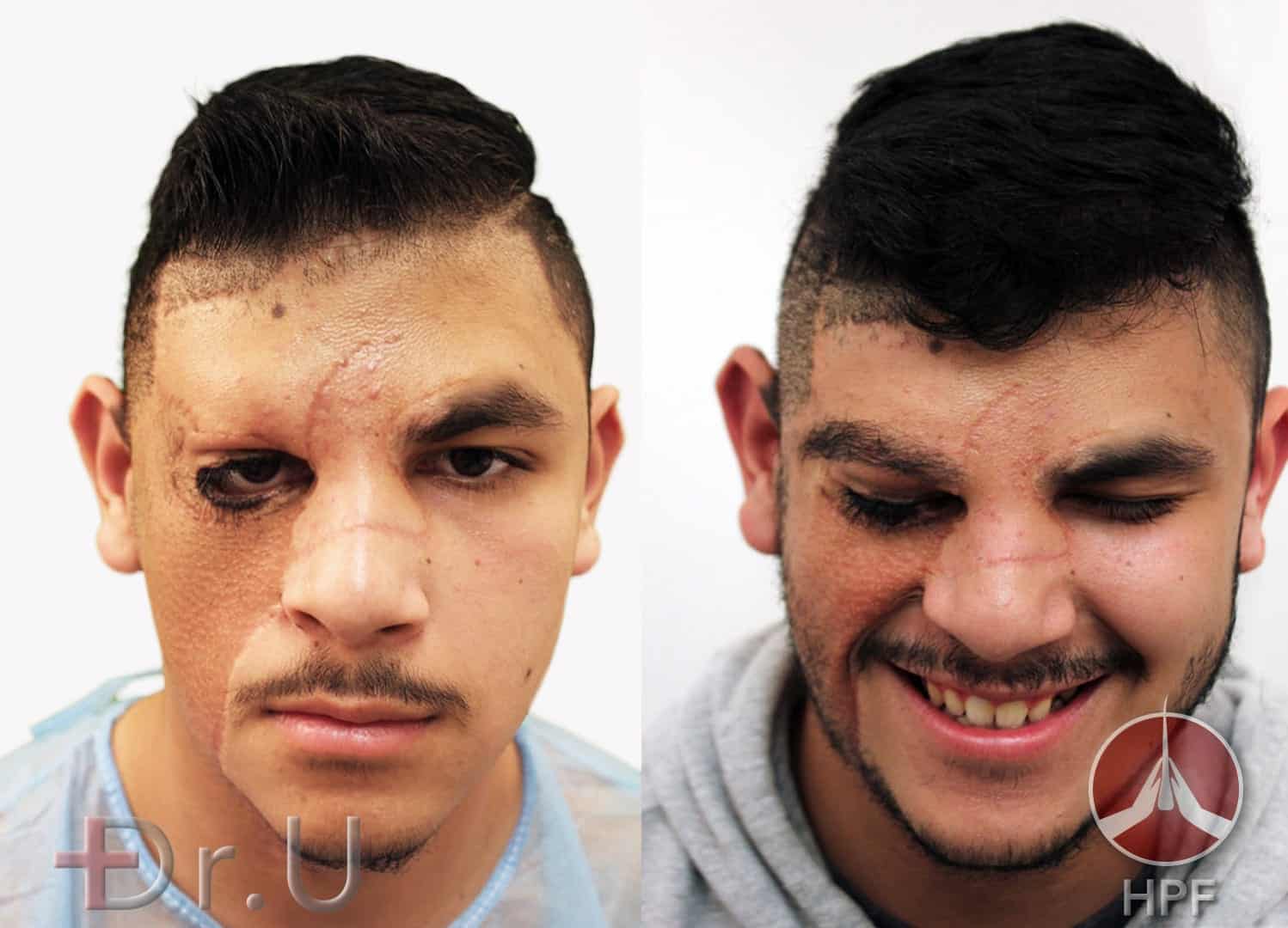 Facial Hair Transplantation Results - Dr. U Reconstruct Eyebrows
