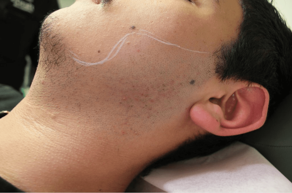 Facial hair transplantation on the left side of the face will advance and improve the contours of the patient's existing beard region Facial hair transplantation on the left side of the face will advance and improve the contours of the patient's existing beard region