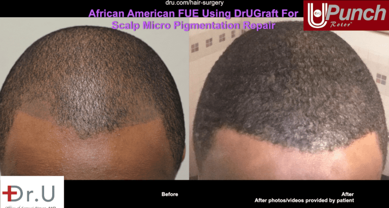 Hairline and temple restoration , including SMP coverage using grafts harvested with Dr.U's intelligent punch and Intuitive FUE system