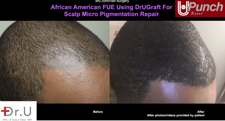 Hair Surgery - Dr. UGraft African American FUE Services - Dr. U Hair ...