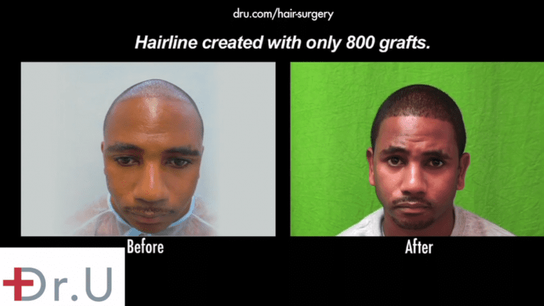 Video - Dr UGraft Hair Restoration for Black African Men Los Angeles