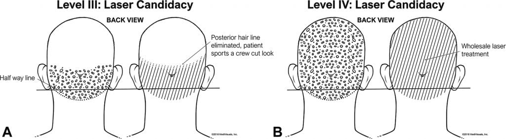 Dr.U’s Selective Treatment Approach For Acne Keloidalis Nuchae Laser ...