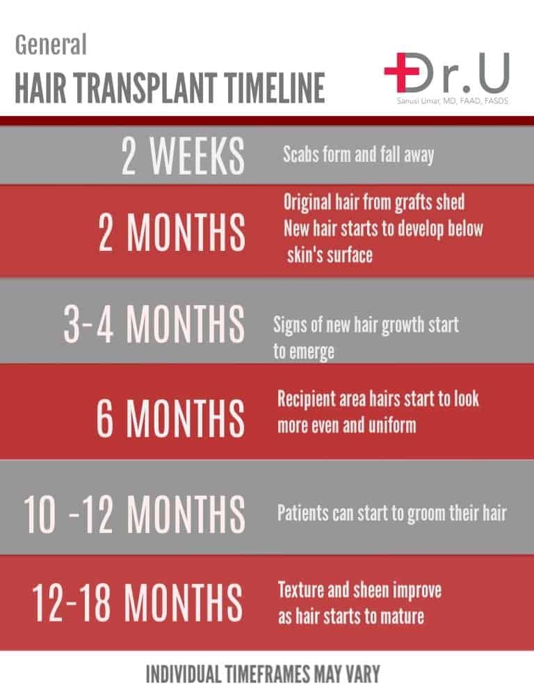  Shares an Overview of the Hair Transplant Process and What To Expect -  Dr. U Hair & Skin Clinic | FUE Hair Restoration, Dermatology and Laser  Surgery | Los Angeles, Manhattan