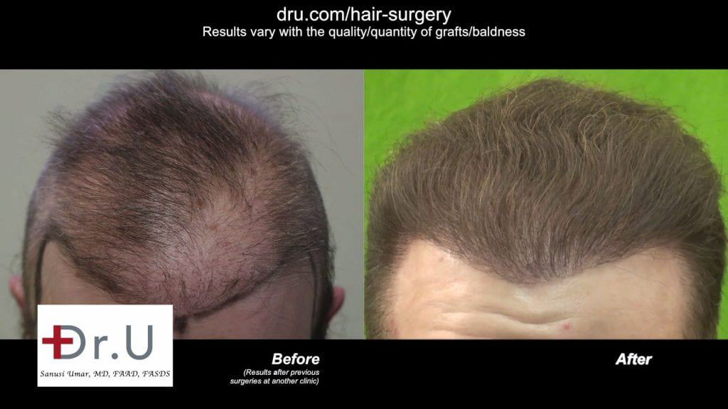 Repairing donor hair depleted patient using DrGraft Los Angeles: Before and After treatment with the Dr.UGraft