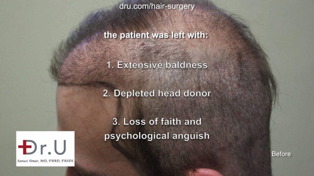 Repairing donor hair depleted patient using DrGraft Los Angeles: hair transplant not enough donor hair