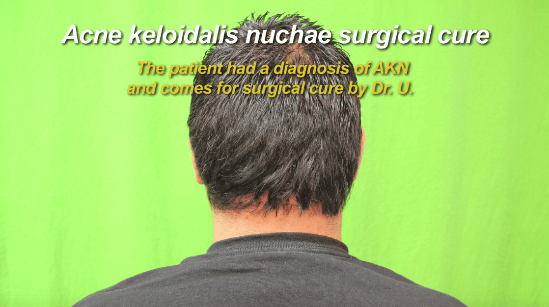 acné keloidalis nuchae antes y después