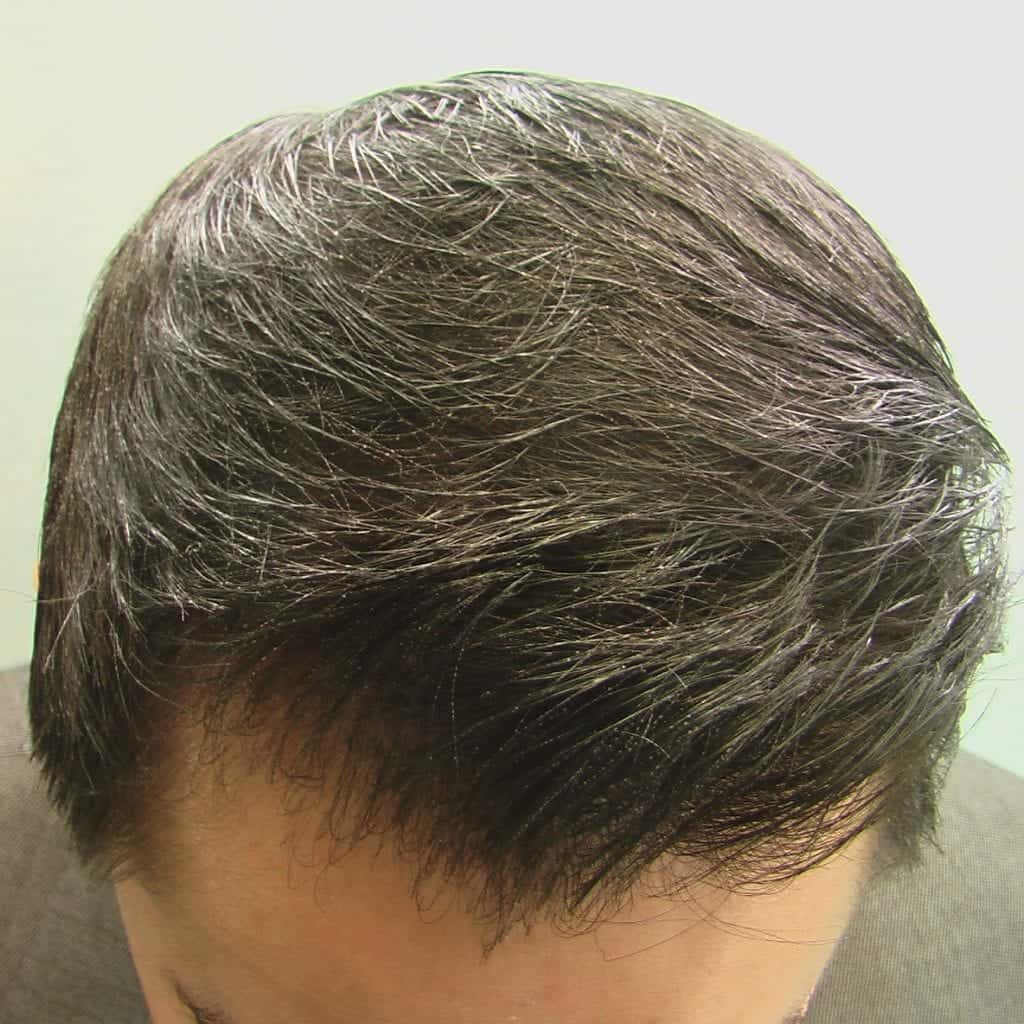 VIDEO: Dr UGraft Asian FUE Hair Transplant Services Los Angeles