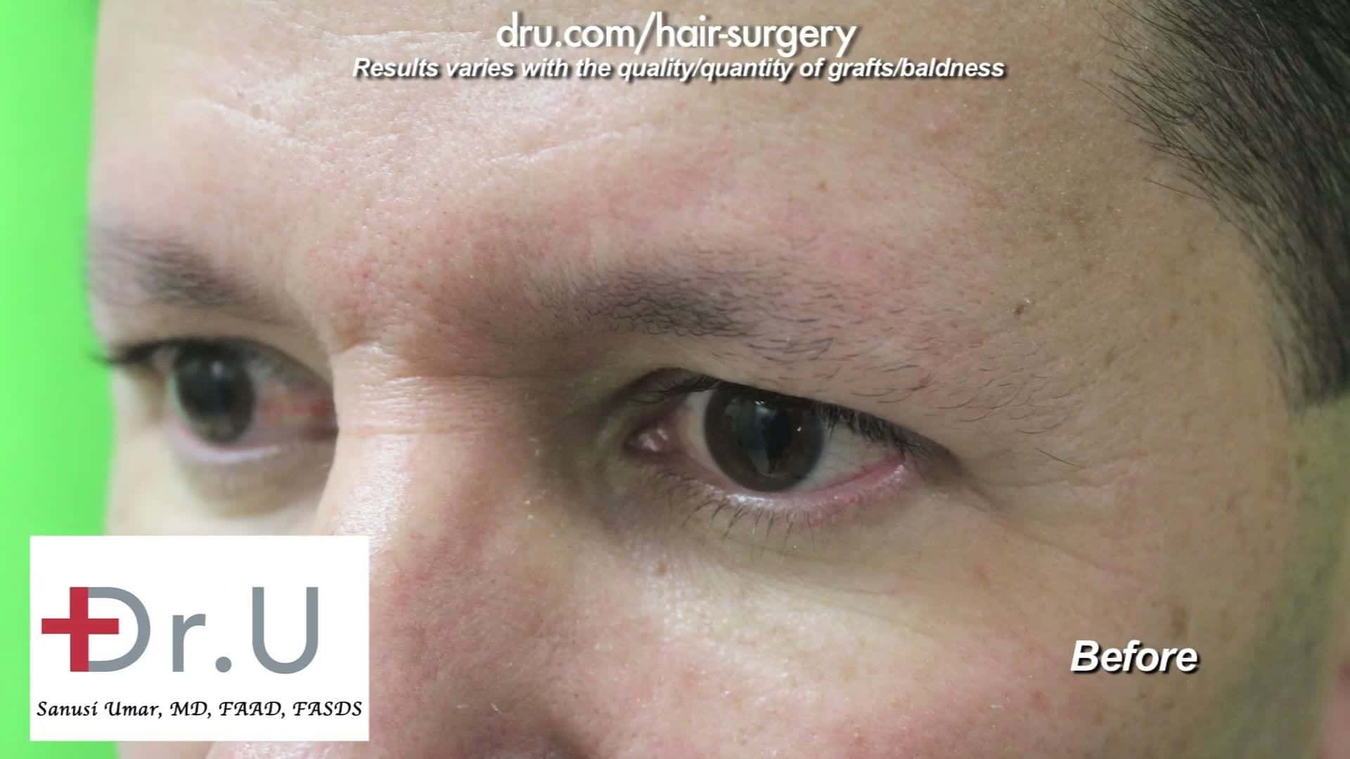 VIDEO: Male Eyebrow Restoration by Dr. Umar in Los Angeles