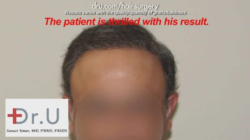 The Severe Hair Loss Restoration Cost was definitely worth it for this NW 7 patient