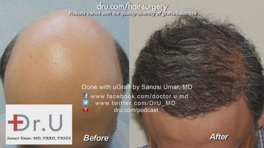 NW 7 Hair Restoration: Before and after photos contrasting the effects of BHT