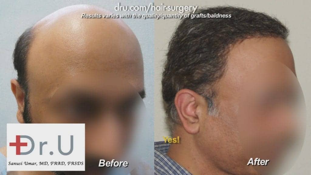 Severe hair loss treatment using the Dr.UGraft BHT system