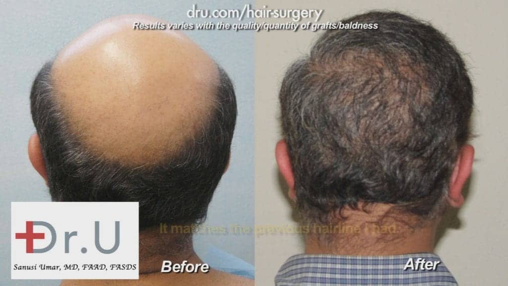 Dramatic results from treatment with the Dr.UGraft