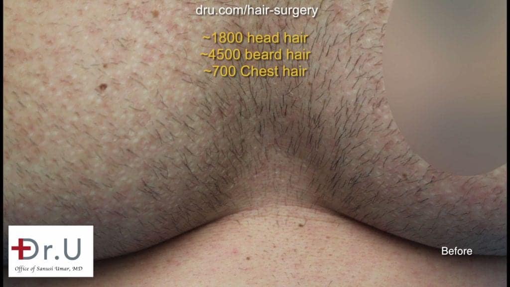 Hair restored with the Dr.UGraft using body hair