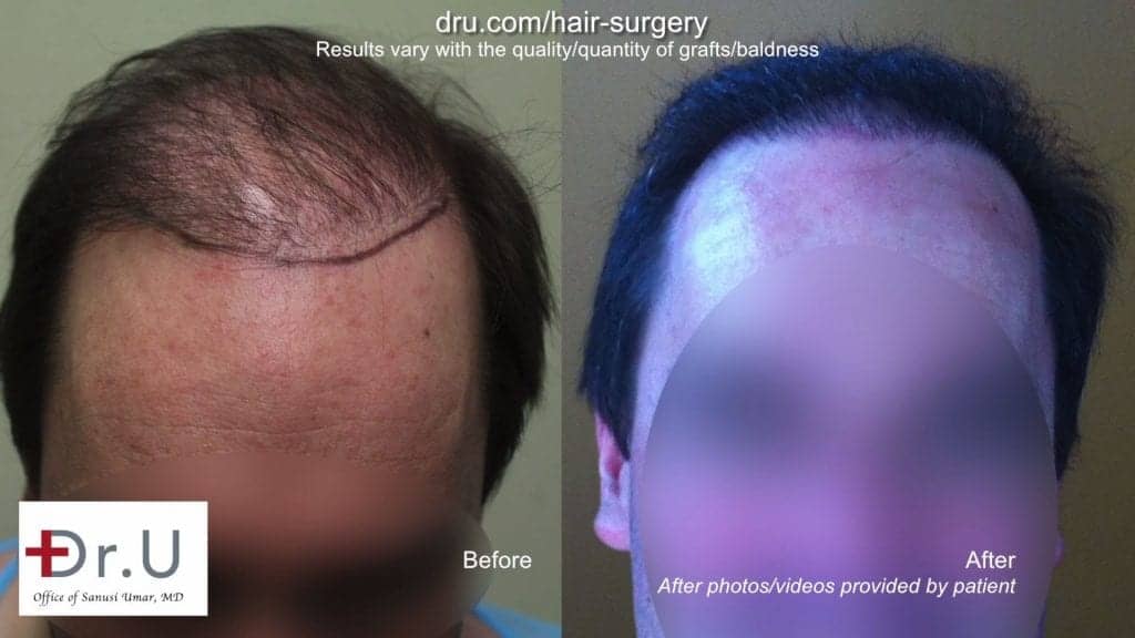 DrUGraft BHT FUE Hair Repair Donor Depleted Norwood 6 Patient