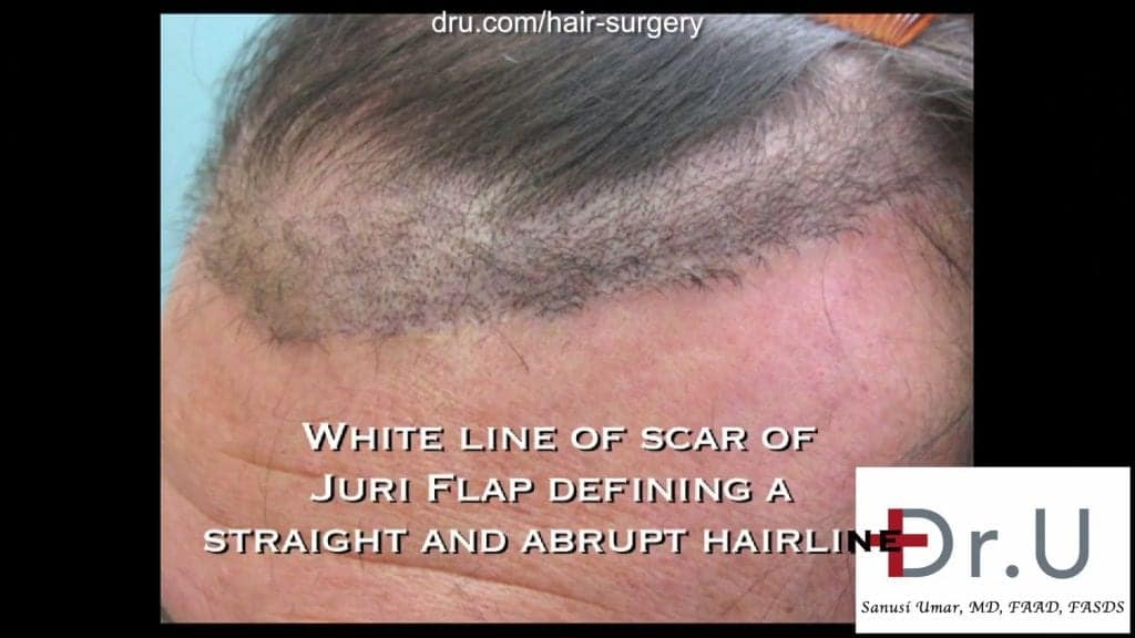 Video - Juri Hair Flap Surgery Problems Fixed by  FUE