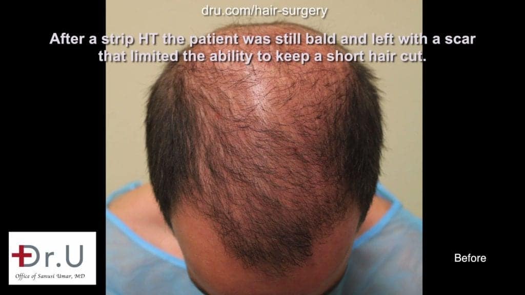 hair transplant timeline video