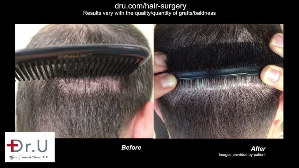 Video - Low Budget Hair Restoration and Scar Repair In Los Angeles