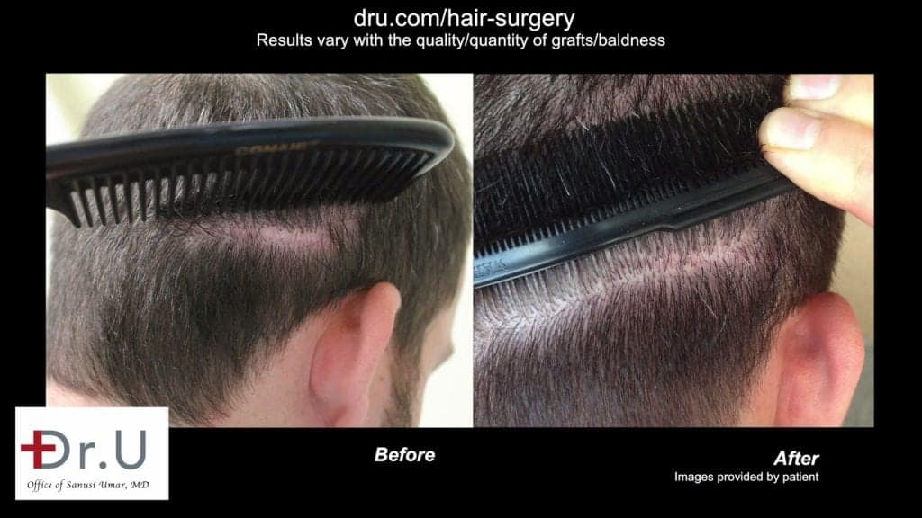 Video - Restoring Hair with the UGraft Procedure