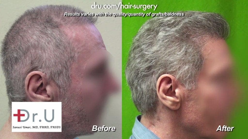 Video - Scalp Reduction and Progressive Hair Loss Repair