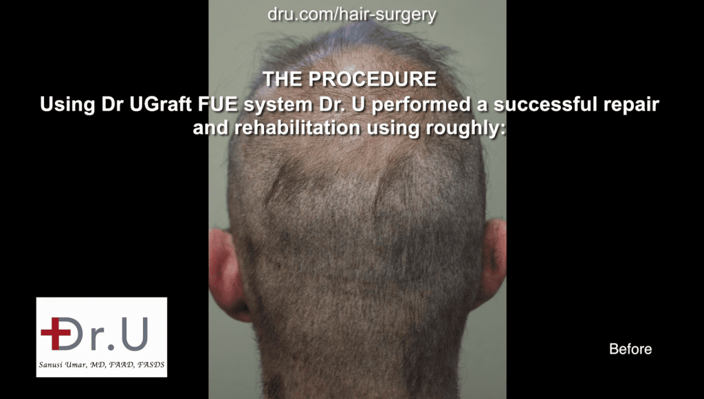 Before Dr.UGraft body hair transplant repair, the patient had a strip scar, depleted donor from strip surgery and multiple FUE and still very bald