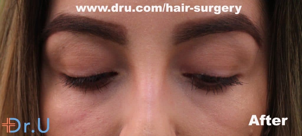 VIDEO: The VeeLashe Pubic Hair Eyelash Transplant Surgery by Dr. U Los  Angeles