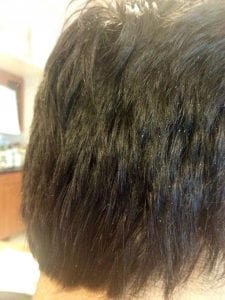Dandruff - Seborrheic Dermatitis, affects Hair Loss and Hair Transplants