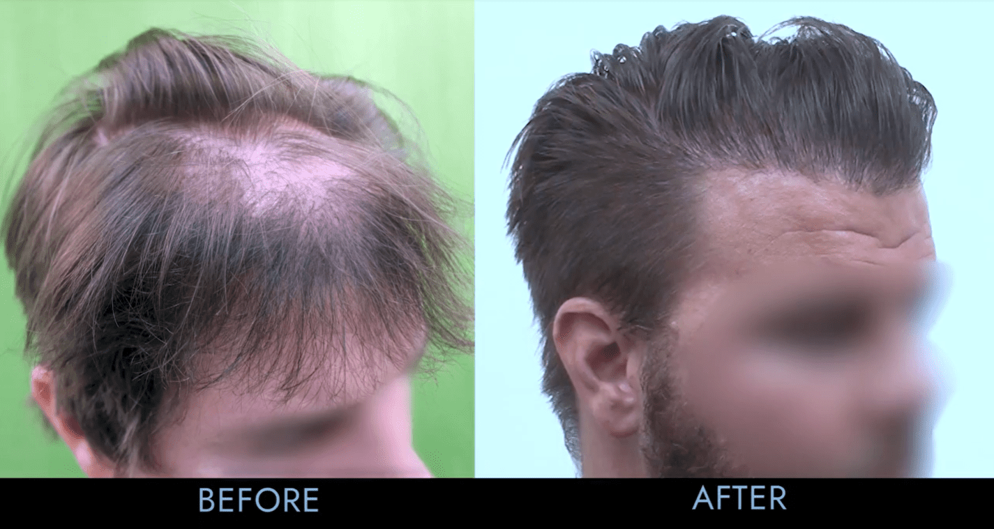 ᐈ 5 best countries for hair transplant overseas