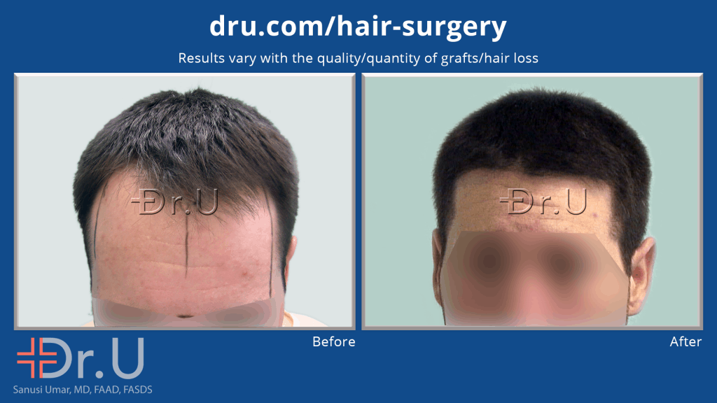VIDEO: The Subtle Hair Transplant By  - Better Than Just Natural