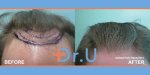 On the left, the planning degree of hairline advancement is shown. Dr U's Subtle hair transplant was used to achieve his goal of remaining a Norwood 3 but with a fuller look as seen on the right*