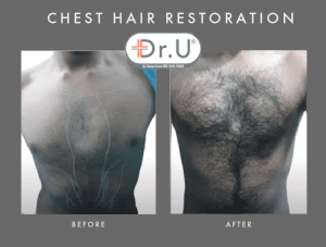 Los Angeles Chest Hair Restoration By Dr.U