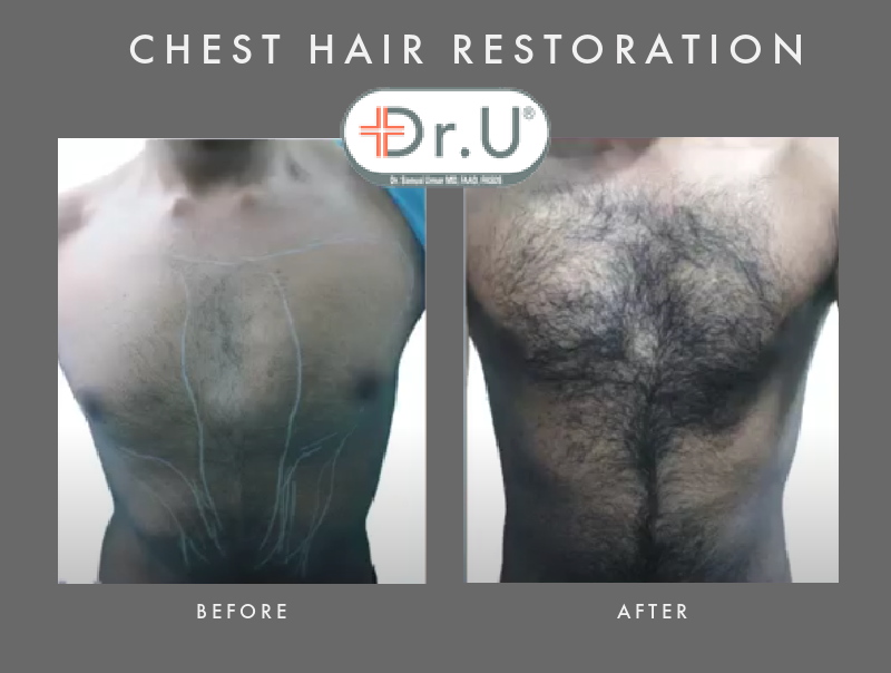 Head to Chest Hair Transplant by  FUE for Beverley Hills Patient