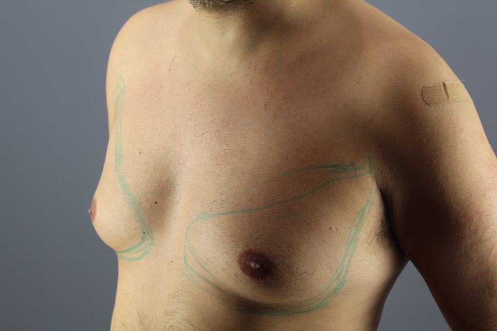 Difference Between Gynecomastia And Chest Fat - PharmEasy Blog