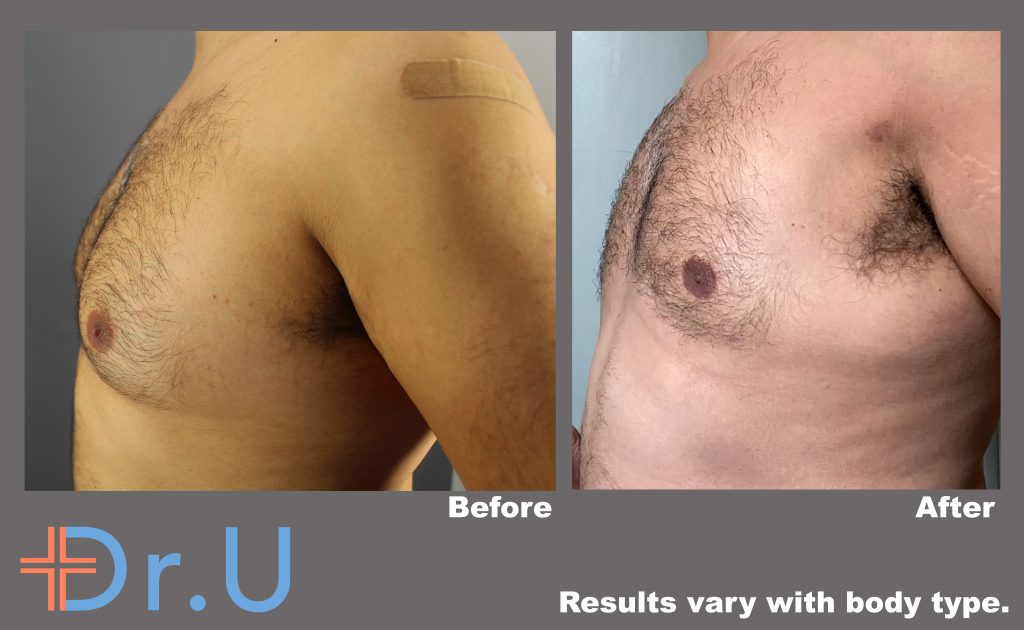 Non-Surgical Gynecomastia in Los Angeles By Dr.U