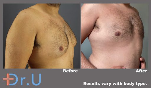 Non-Surgical Gynecomastia in Los Angeles By Dr.U