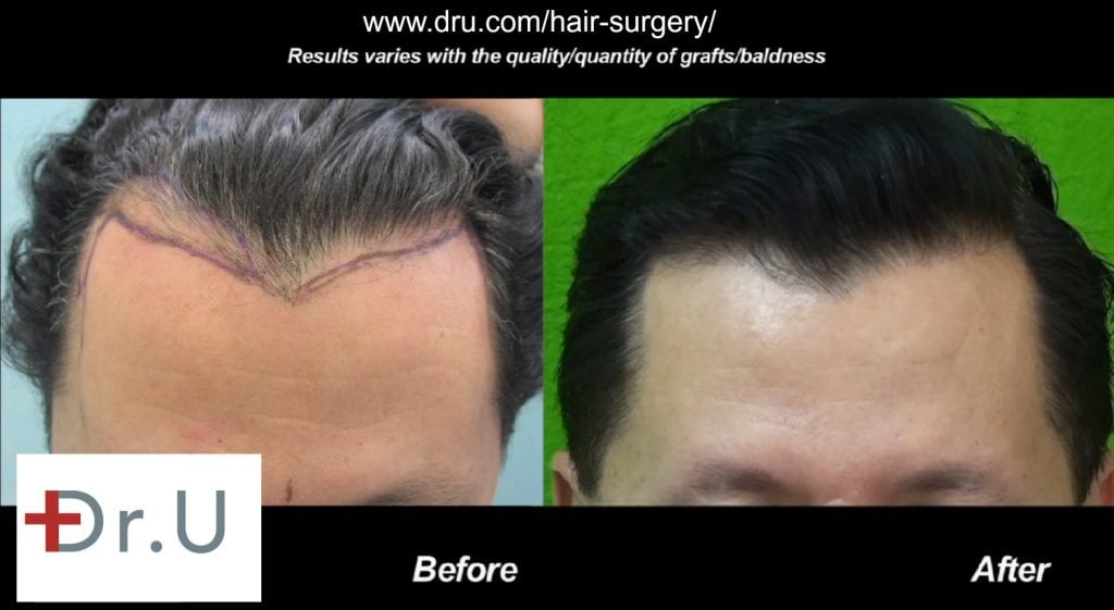 The Truth About Why Initial Growth In Hair Transplant Is Sometimes Weird Looking – Q&A