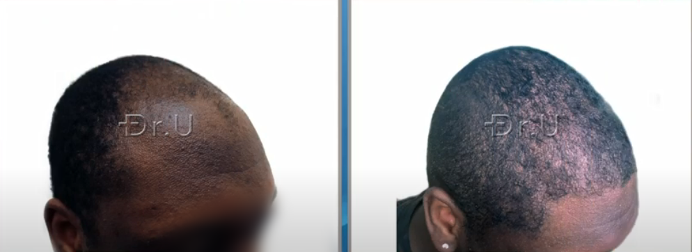 VIDEO - Hair Transplant For A Young 20 Year Old Black Male