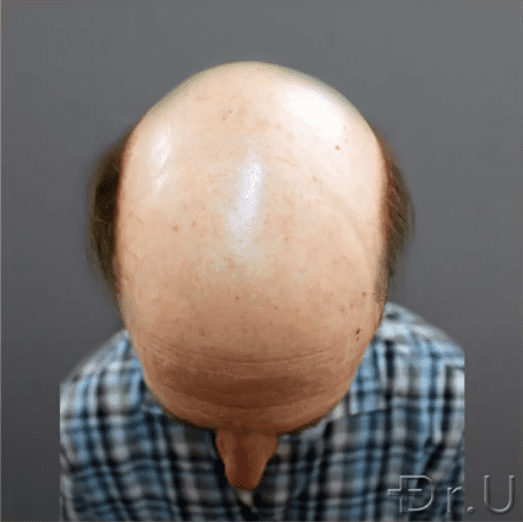 Bald Hair Transplant With Dr.UGraft Zeus