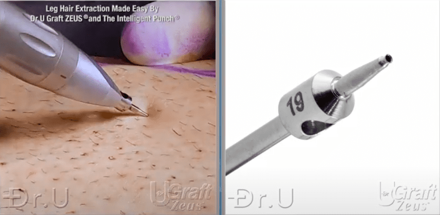 Dr.U busy at work, harvesting leg hair follicles using his Dr.UGraft Zeus technology and his Intelligent Punch* Dr.U busy at work, harvesting leg hair follicles using his Dr.UGraft Zeus technology and his Intelligent Punch*